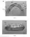 Fig. 05 - Dental implant prosthesis
