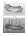 Fig. 06 - Dental implant prosthesis