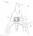 Fig. 09 - ATTACHMENT FOR DENTURE
