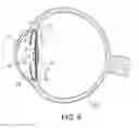 Fig. 06 - Intraocular lens assembly