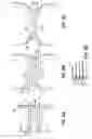 Fig. 17 - Apparatus and methods for implanting a replacement heart valve