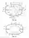 Fig. 03 - Mitral bileaflet valve