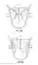 Fig. 12 - Mitral bileaflet valve