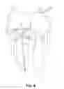 Fig. 10 - Implantable transcatheter intracardiac devices and methods for treating incompetent atrioventricular valves