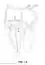 Fig. 11 - Implantable transcatheter intracardiac devices and methods for treating incompetent atrioventricular valves