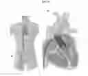Fig. 05 - VALVE PROSTHESIS