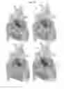 Fig. 11 - VALVE PROSTHESIS