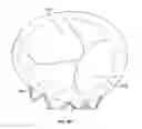 Fig. 53 - Collapsible prosthetic heart valves