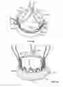 Fig. 56 - Collapsible prosthetic heart valves