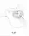 Fig. 22 - Spinal implant with fluid delivery capabilities