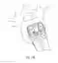 Fig. 26 - Spinal implant with fluid delivery capabilities