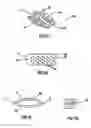Fig. 02 - INTERVERTEBRAL DISC SPACER