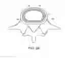 Fig. 04 - IN-SITU FORMED INTERVERTEBRAL FUSION DEVICE AND METHOD