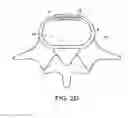 Fig. 06 - IN-SITU FORMED INTERVERTEBRAL FUSION DEVICE AND METHOD