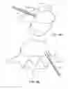 Fig. 09 - IN-SITU FORMED INTERVERTEBRAL FUSION DEVICE AND METHOD