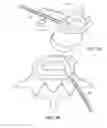 Fig. 10 - IN-SITU FORMED INTERVERTEBRAL FUSION DEVICE AND METHOD