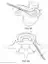 Fig. 12 - IN-SITU FORMED INTERVERTEBRAL FUSION DEVICE AND METHOD