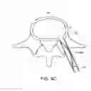 Fig. 16 - IN-SITU FORMED INTERVERTEBRAL FUSION DEVICE AND METHOD
