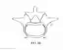 Fig. 28 - IN-SITU FORMED INTERVERTEBRAL FUSION DEVICE AND METHOD