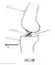 Fig. 14 - Devices, Systems, and Methods for Impacting Joint Implant Components