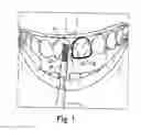 Fig. 02 - FLUORIDE COMPOSITION FOR TREATING TEETH