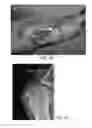 Fig. 18 - Method of treatment utilizing an acellular amnion derived therapeutic composition