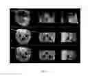 Fig. 06 - Multimodal imaging of fibrin