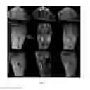 Fig. 08 - Multimodal imaging of fibrin