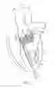 Fig. 02 - Catheter-based heart support system and method of implanting thereof