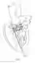 Fig. 03 - Catheter-based heart support system and method of implanting thereof
