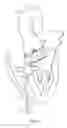 Fig. 06 - Catheter-based heart support system and method of implanting thereof
