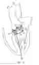 Fig. 21 - Catheter-based heart support system and method of implanting thereof