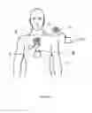 Fig. 03 - Heart assist system and/or device