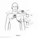 Fig. 04 - Heart assist system and/or device