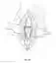 Fig. 19 - Vascular access ports and related methods