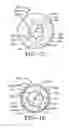 Fig. 14 - Catheter