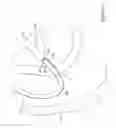 Fig. 14 - Biliary access catheter system and methods for accessing the biliary tree