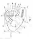 Fig. 14 - ANTISEPTIC APPLICATOR