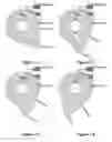 Fig. 07 - Incremental deployment device