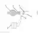 Fig. 167 - Longitudinally variable vascular treatment devices