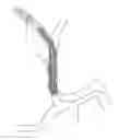 Fig. 197 - Longitudinally variable vascular treatment devices