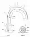 Fig. 02 - Delivery system having an integral centering mechanism for positioning a valve prosthesis in situ