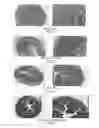 Fig. 04 - Method for treating intestinal fibrosis