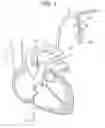 Fig. 07 - Devices and methods for minimally invasive coronary bypass and other treatments