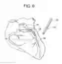Fig. 08 - Devices and methods for minimally invasive coronary bypass and other treatments