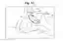 Fig. 03 - Devices and Methods For Minimally Invasive Access to Sinuses And Treatment of Sinusitis
