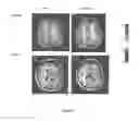 Fig. 07 - Imaging reductions in cerebrovascular reactivity