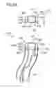 Fig. 03 - Implantable vessel fluid sensor