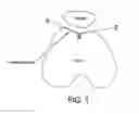 Fig. 02 - Trochlea-angle measurement template