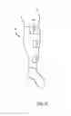 Fig. 03 - Two-layer tension measurement system for compression garments